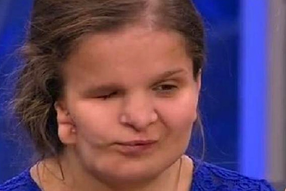 Катя родилась с редким заболеванием - синдромом Гольденхара: это врожденная патология, при которой неправильно развивается одна половина лица