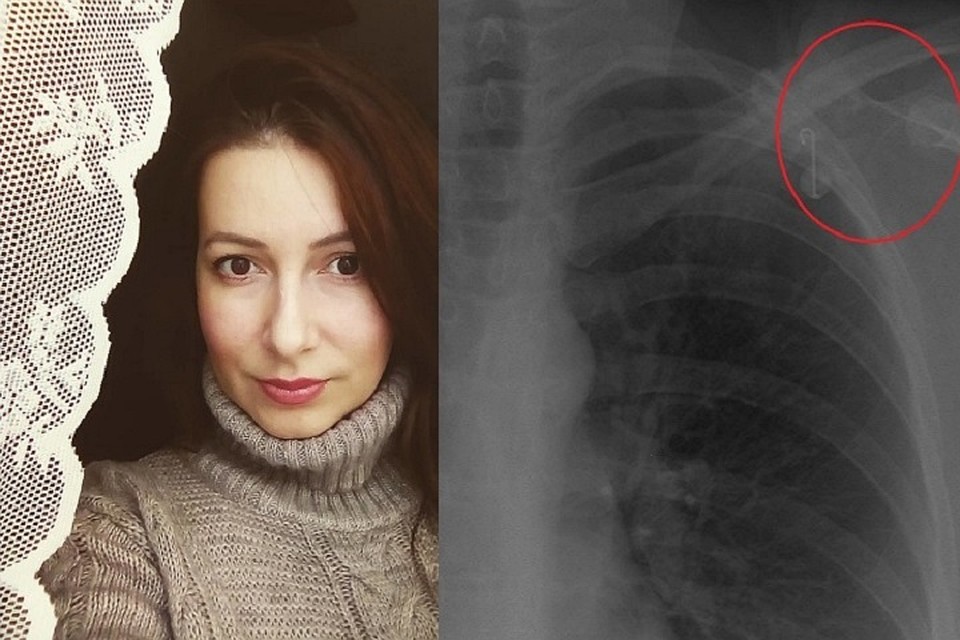 Плечо беспокоило Елену десять лет. Но медики только разводили руками: «Такое после любого вмешательства может быть». Фото: https://www.instagram.com/khmeleva_photo/
