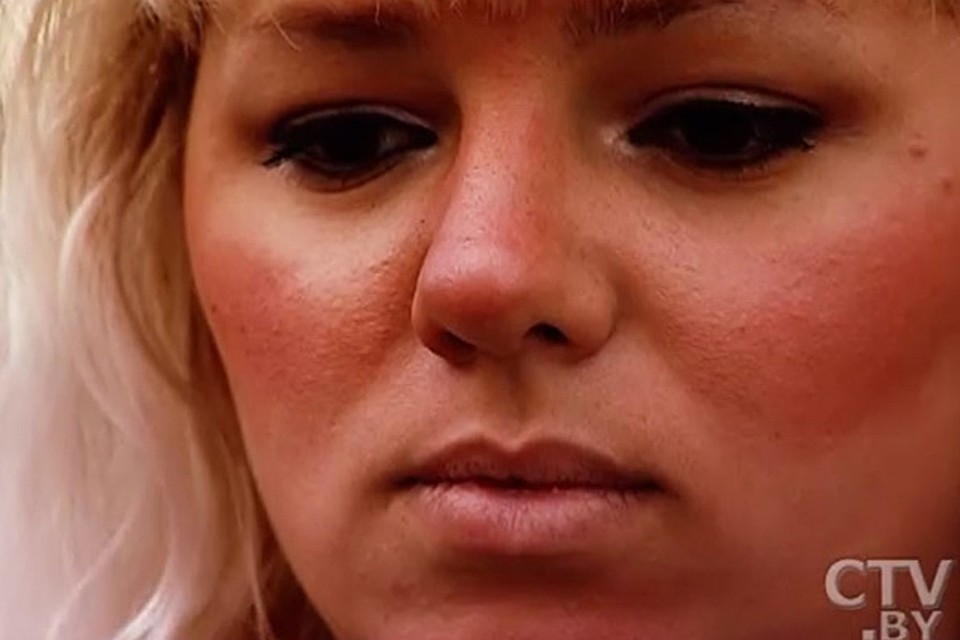 Алена (на фото) утверждает, что всего лишь сыграла обгоревшую девушку, а с ней все в порядке.