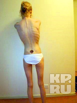 Больным анорексией (anorexia nervosa) еда кажется пресной и безвкусной в отличие от женщин, не страдающих расстройствами пищевого поведения. Причем возможность наслаждаться потребляемой пищей может не возвратиться даже после полного выздоровления. Раз в мозге нарушен процесс психологического вознаграждения за съеденное, то страдающие анорексией не хотят есть, даже будучи физиологически голодными.