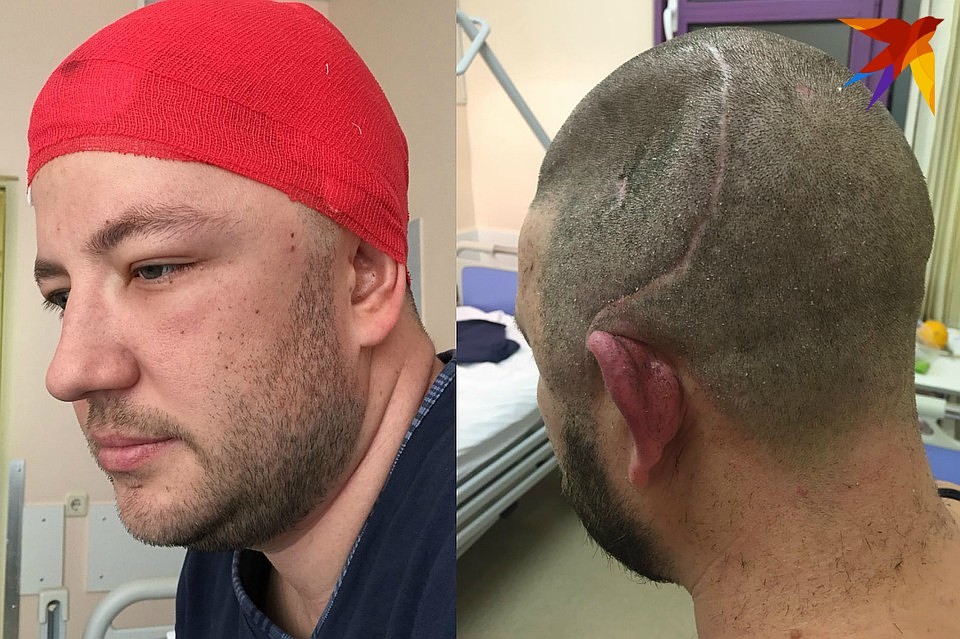 Павел только учится жить заново, однако последствия тяжелейшей травмы продолжают давать о себе знать.