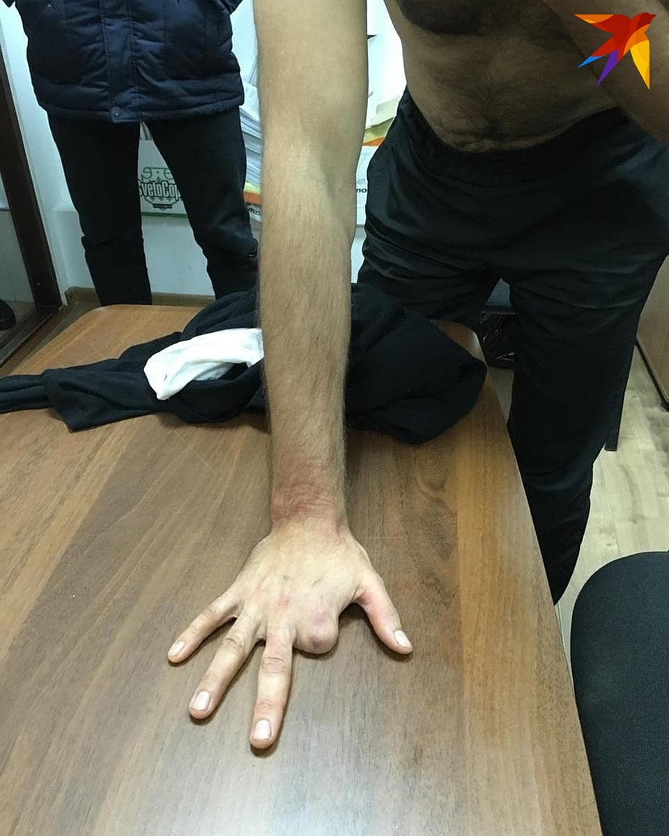 В полиции указывают на приметы беглого задержанного. У Антона Санникова нет пальца