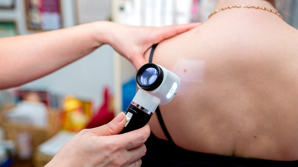 Лучшие методы лечения меланомы кожи