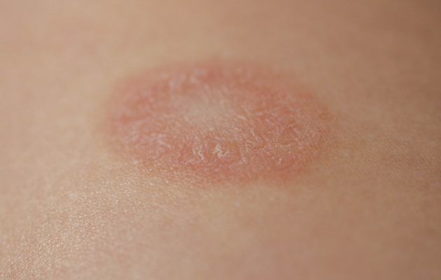 Розовый лишай у человека