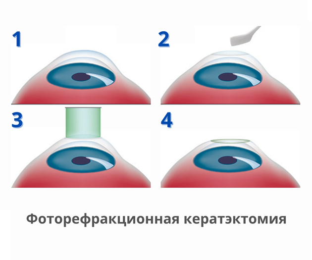 Фоторефракционная кератэктомия