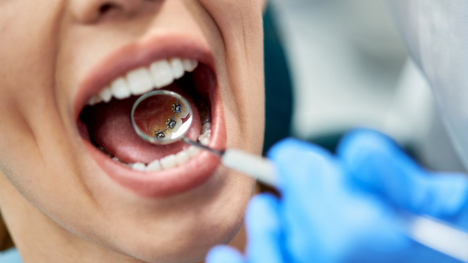 Лингвальные брекеты