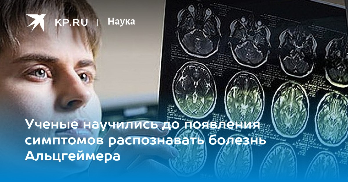 Ученые научились до появления симптомов распознавать болезнь Альцгеймера