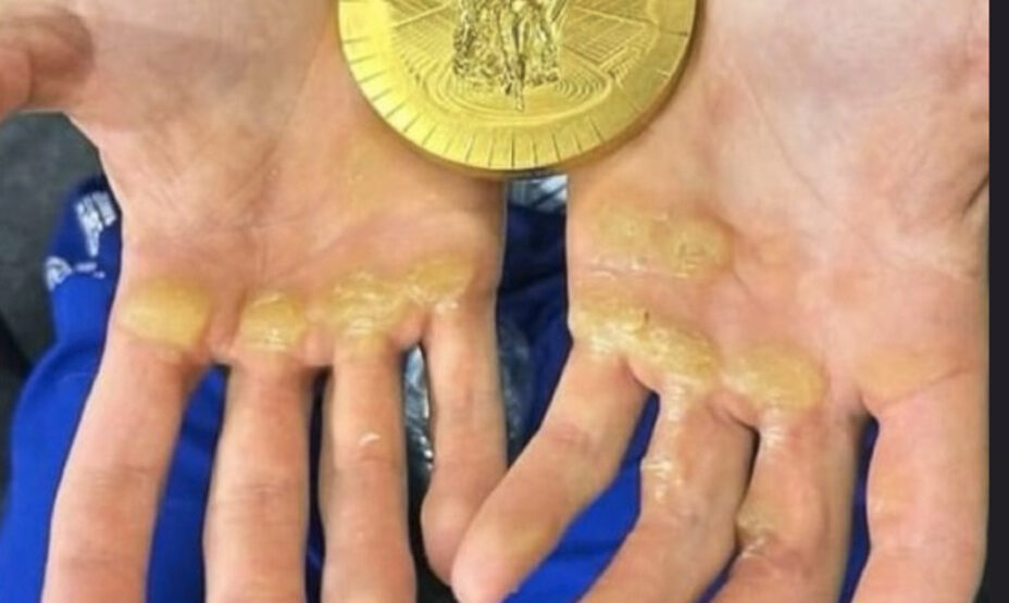 У румына на руках следы от золота ОИ, фото соцсети